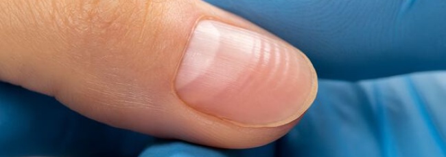 Линии Бо: горизонтальные борозды на ногтях