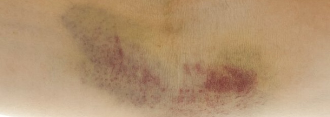 Усе, що потрібно знати про гематому