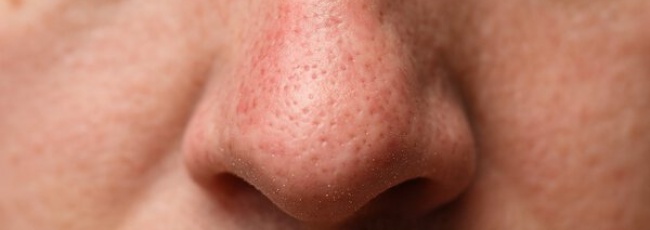 Клещи Demodex на лице: причины и лечение