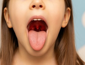 Что такое тонзиллит и как его лечить