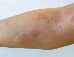 Що таке червоний вовчак і як він проявляється в організмі