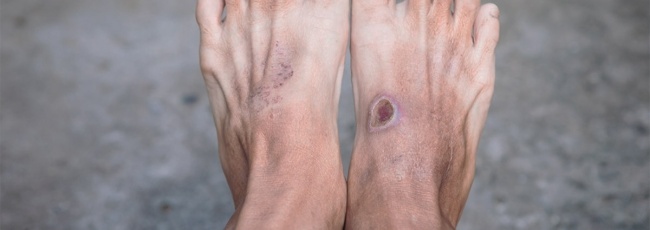 Діабетична стопа: ураження стоп при діабеті