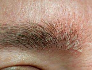 Себорейний дерматит: причини, симптоми, лікування