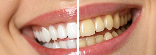 6 натуральных способов отбеливания зубов
