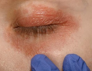 Блефарит и как его лечить