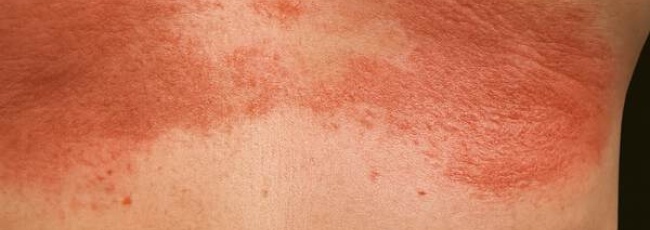 Інтертріго: запалення у складках шкіри