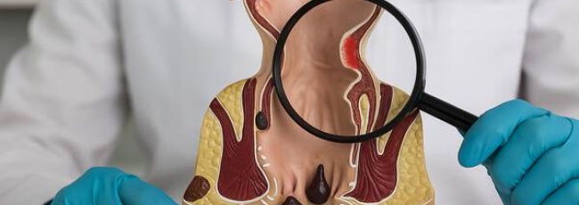 Проктит: причины, симптомы и лечение