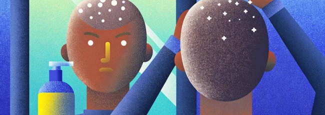 Причини виникнення лупи: детальний розбір