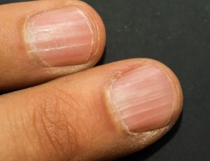 Оніхорексис: вертикальні борозенки на нігтях