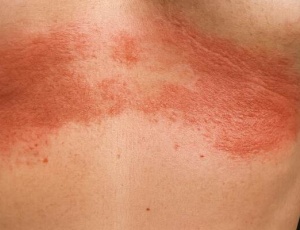 Интертриго: воспаление в складках кожи