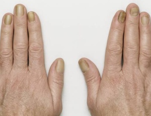 Что такое синдром желтых ногтей