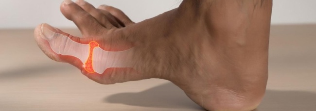 Подагра: причины, симптомы, лечение