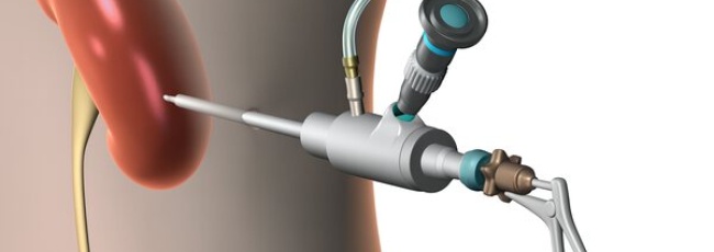 Що таке перку́танна нефролітотомія і коли вона потрібна