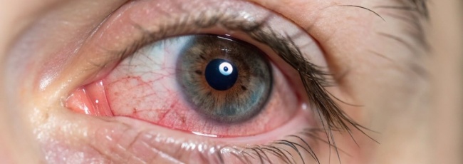 Домашнє лікування кон’юнктивіту: як зняти почервоніння очей 