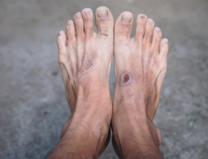 Діабетична стопа: ураження стоп при діабеті