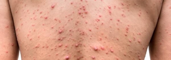 Вітряна віспа у дорослих і як уникнути ускладнень