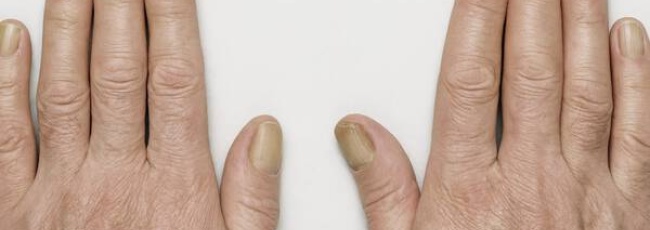 Що таке синдром жовтих нігтів