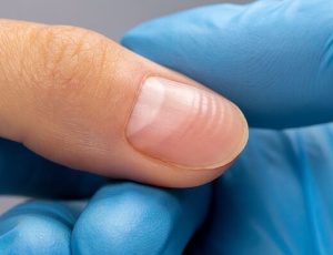 Линии Бо: горизонтальные борозды на ногтях