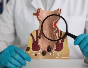 Проктит: причини, симптоми та лікування