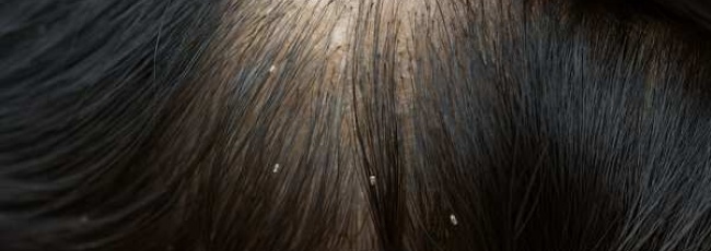 Педикульоз: воші у людини