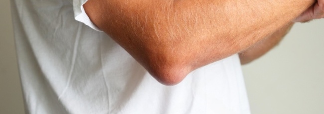 Бурсит ліктя: причини, симптоми, лікування