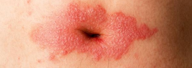 Псоріаз у пупку: причини появи та характерні прояви