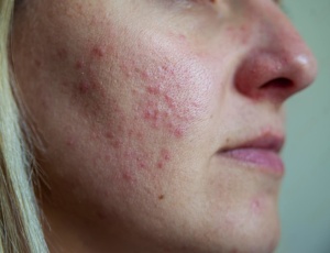 Акне при синдроме поликистозных яичников: причины, лечение и уход