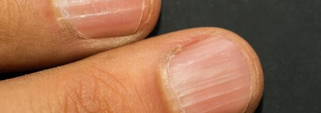 Онихорексис: вертикальные бороздки на ногтях