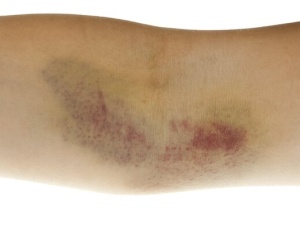 Все, что нужно знать о гематоме