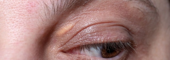 Ксантелазма: жовті плями на повіках