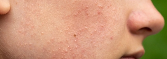 Грибковое акне: причины, симптомы и как от него избавиться