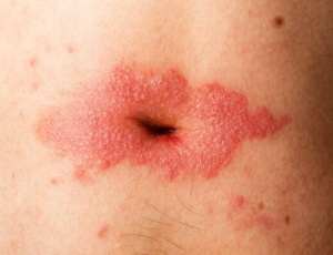 Псориаз в пупке: причины появления и характерные проявления