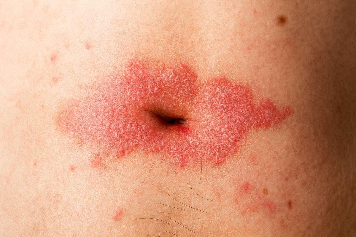 Псориаз в пупке: причины появления и характерные проявления