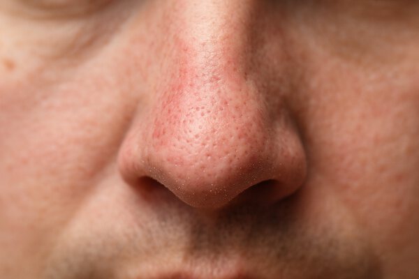 Клещи Demodex на лице: причины и лечение