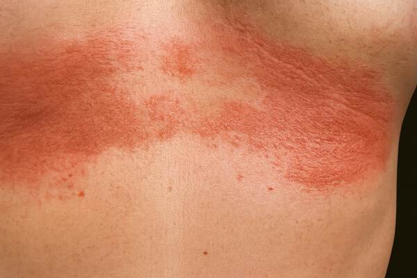 Интертриго: воспаление в складках кожи