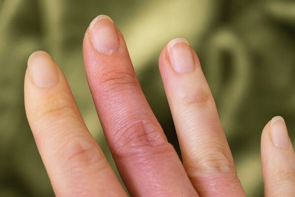 Синдром Рейно: пальцы меняют цвет и немеют