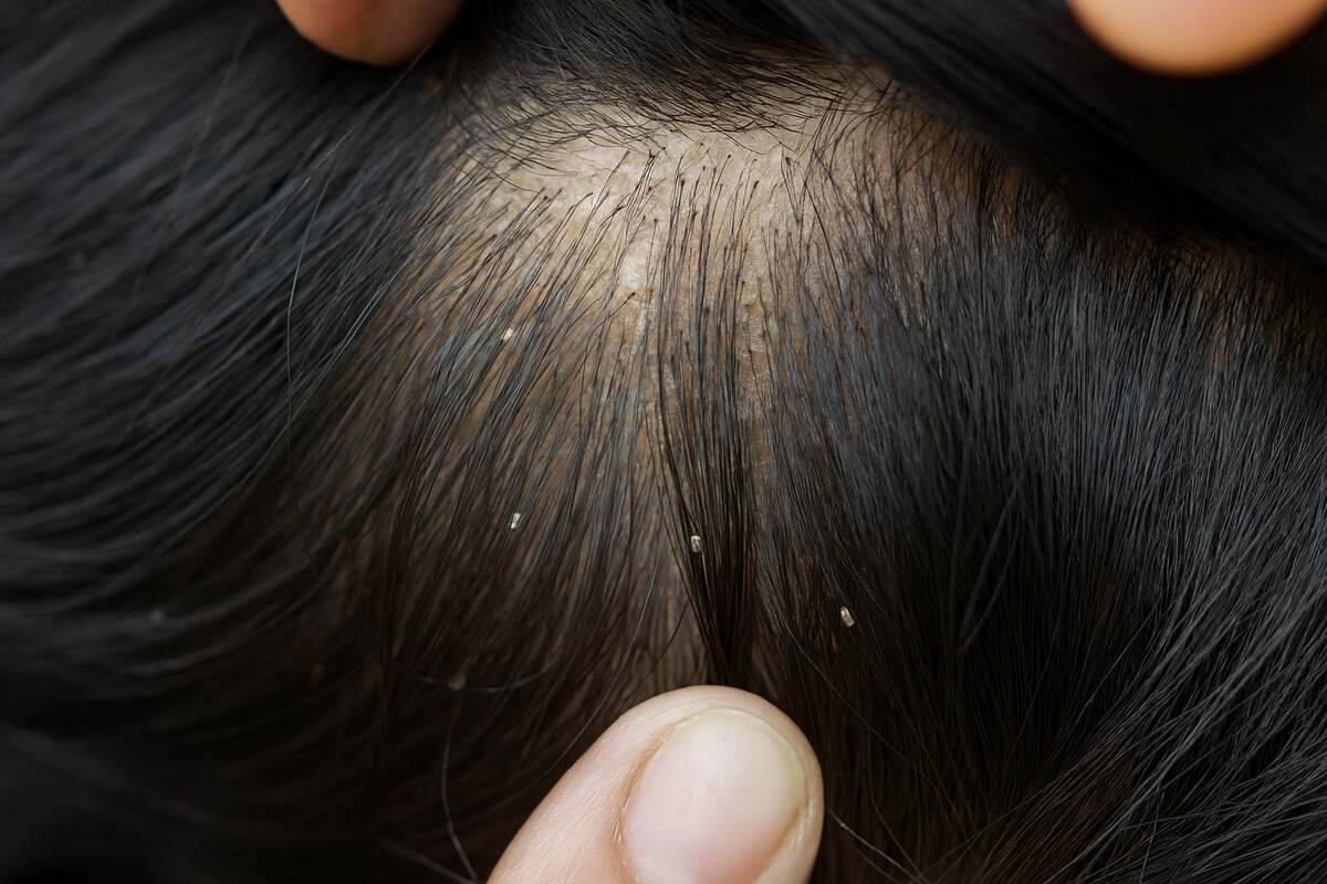 Педикулез: вши у человека