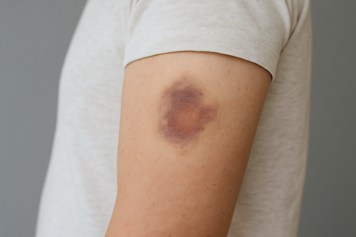 Синці на тілі: випадковість чи сигнал хвороби?