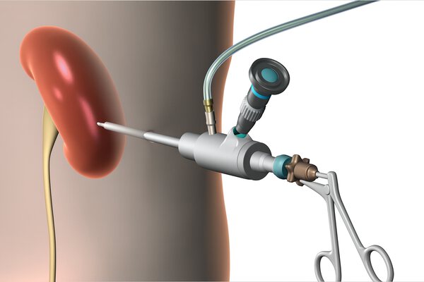 Що таке перку́танна нефролітотомія і коли вона потрібна