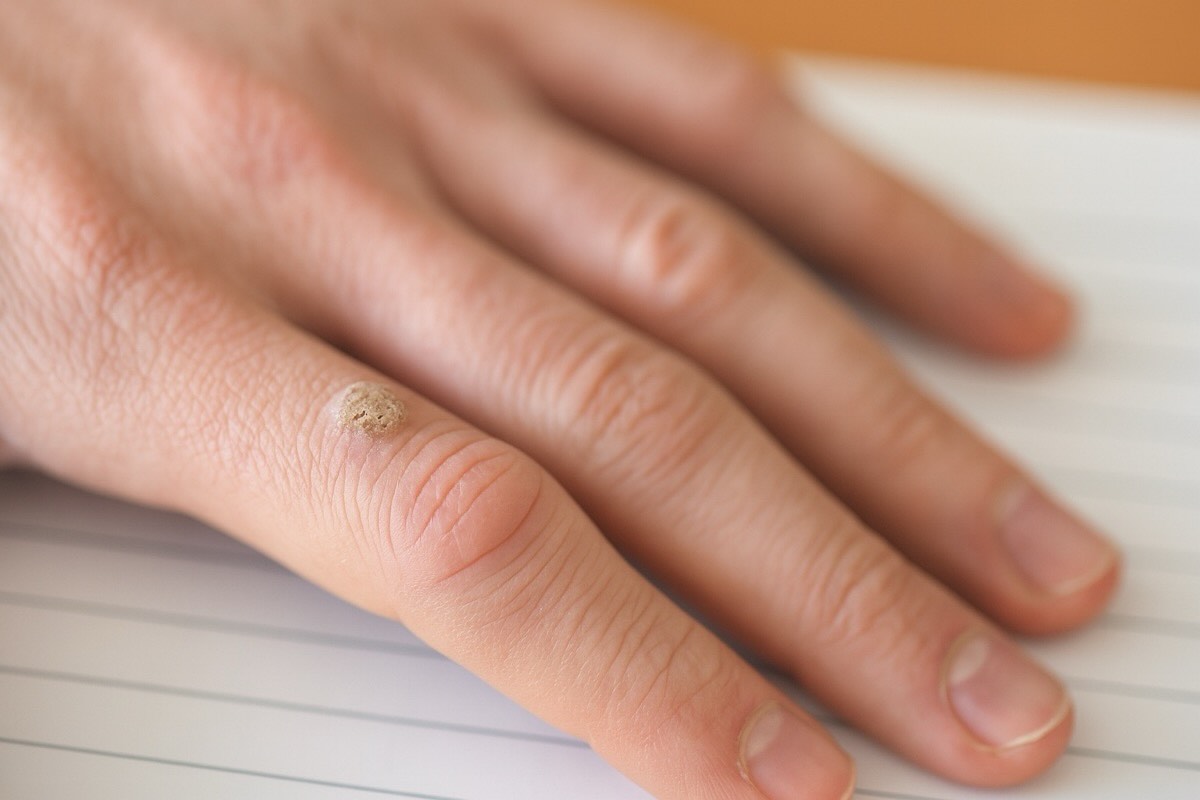 Що таке бородавки: види, причини, лікування